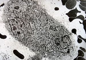 F,25y. | giant multinuclear osteoclast - aneurysmatic cyst - tibia